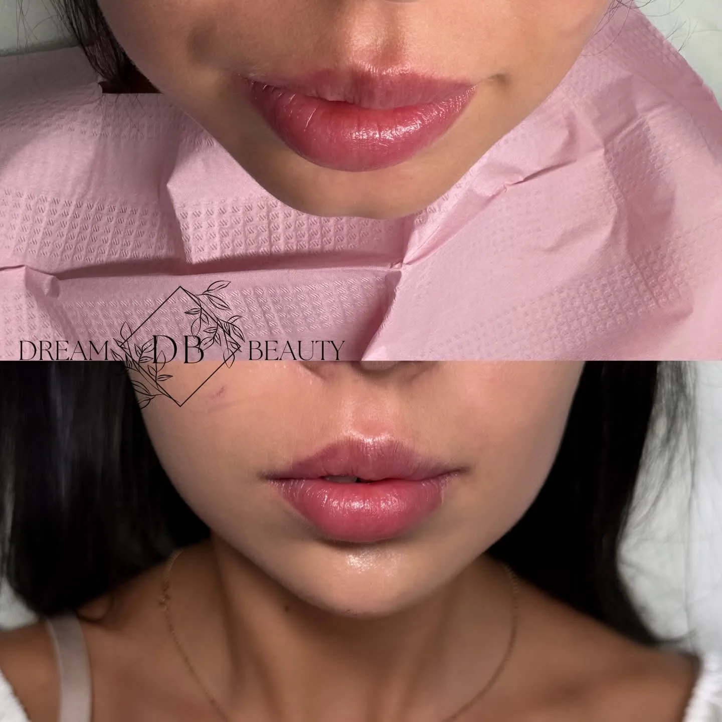 Zestawienie ust przed i po zabiegu modelującym w Dream Beauty